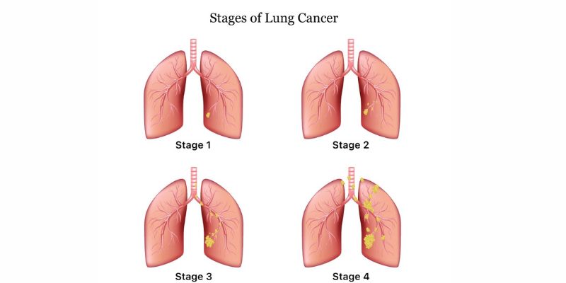 Lung Cancer