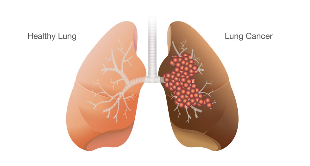 Lung Cancer